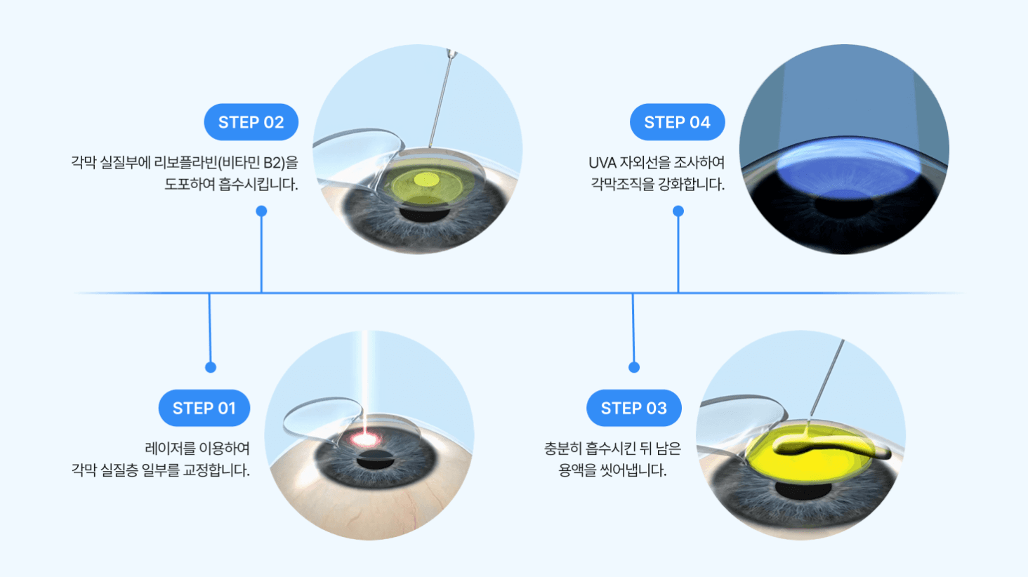 엑스트라 라섹이란?