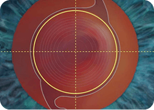 인공수정체 정위치 삽입