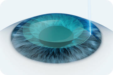 실질조각을 꺼내기 위한 2mm의 절개창 만들기