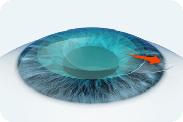절개창을 통해 실질조각(렌티큘) 꺼내기