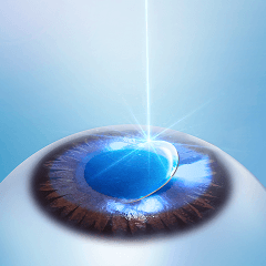 각막 상피 레이저 제거