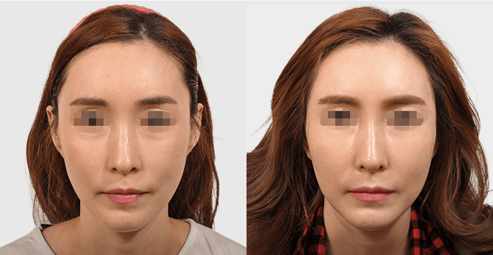 胶原蛋白注射 #1 术后