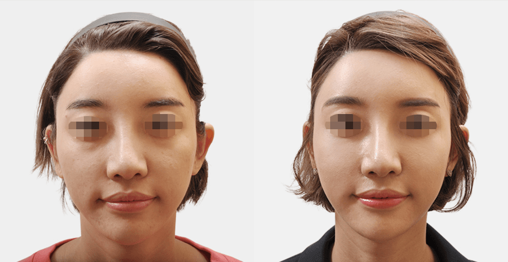 胶原蛋白注射 #2 治疗3个月后