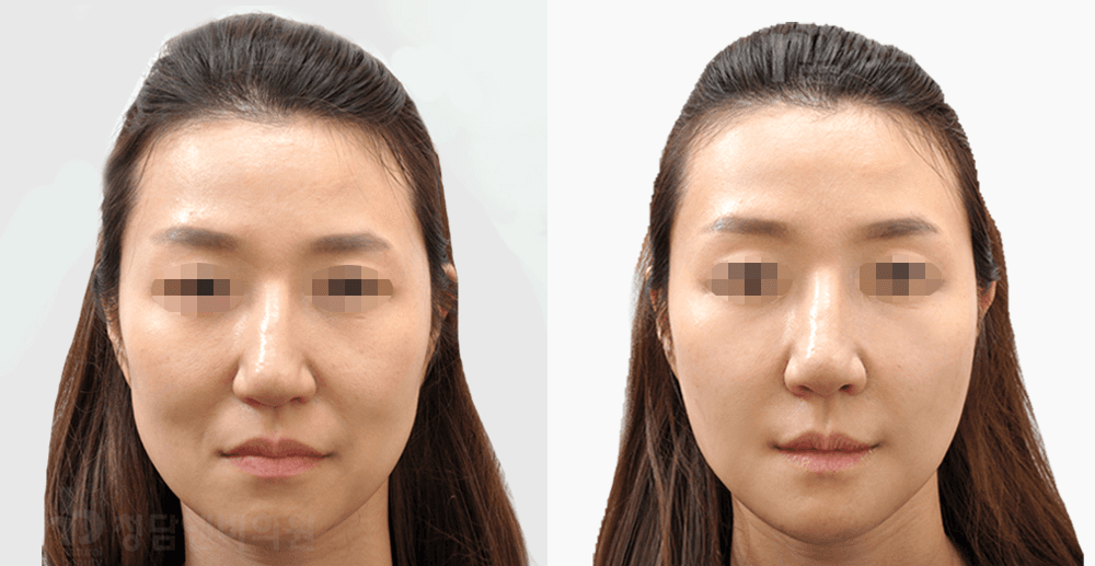 胶原蛋白触碰 #1 治疗1个月后