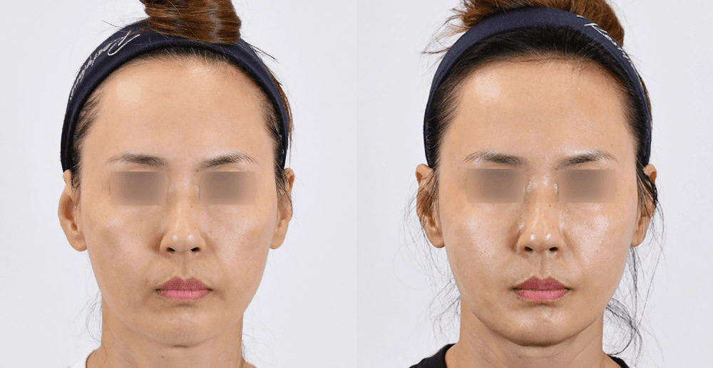 胶原蛋白触碰 #2 治疗1个月后