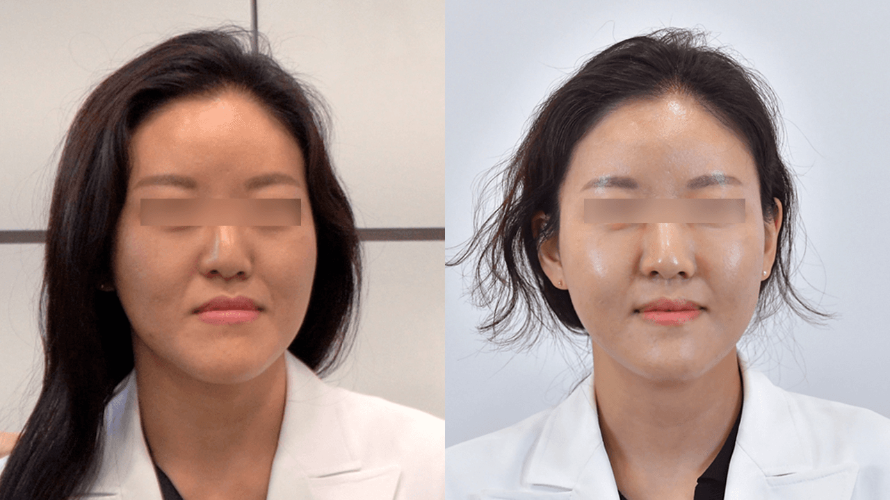 胶原蛋白触碰 #3 术后