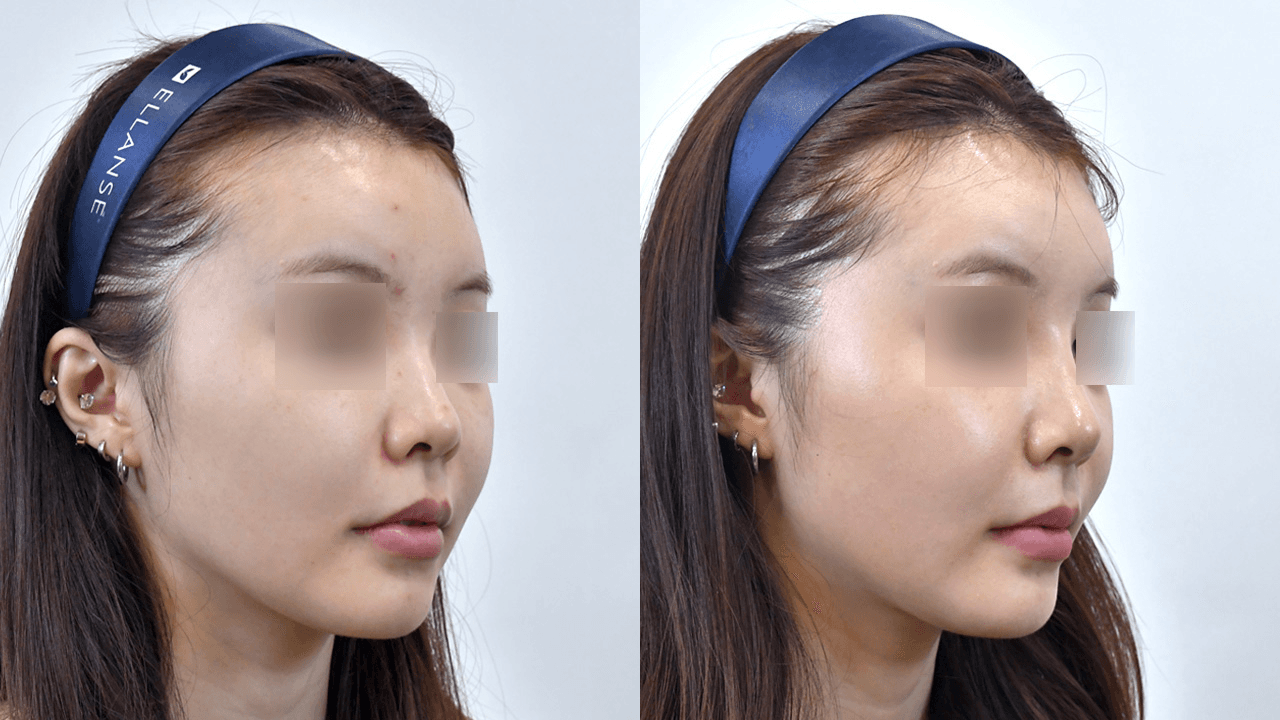 魔法鼻 #1 治疗1周后 (45°)