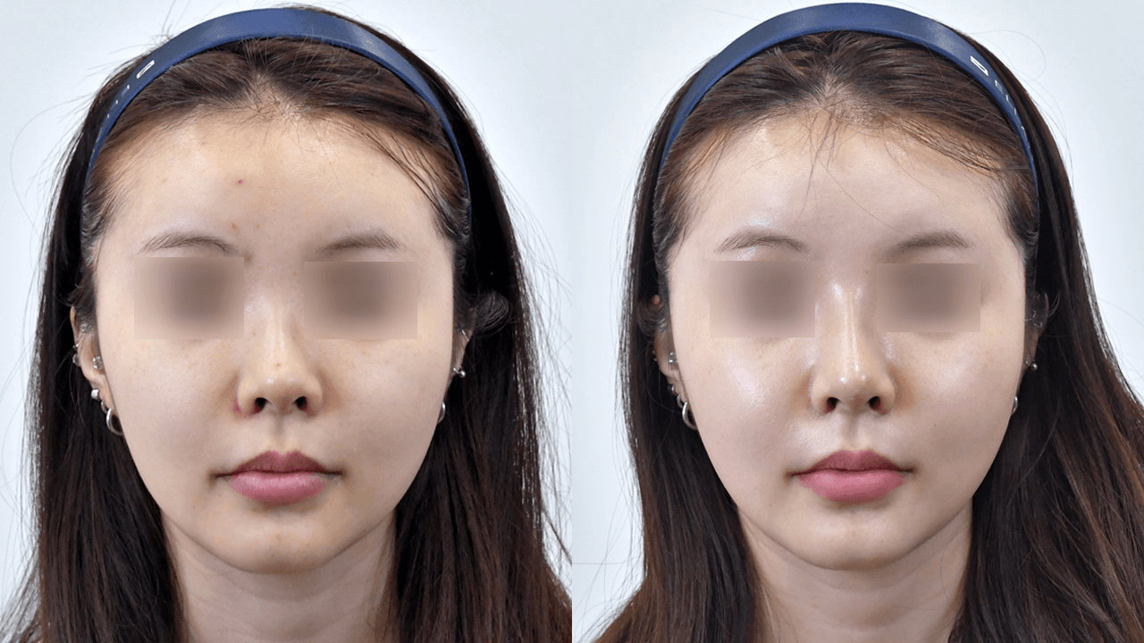 魔法鼻 #1 治疗1周后