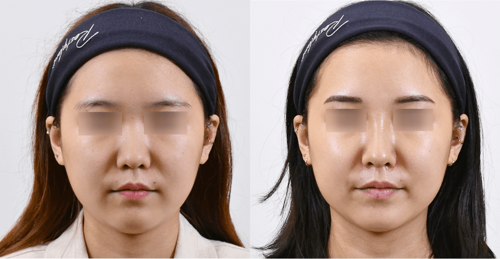 魔法鼻 #2 治疗1个月后