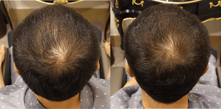 Regenera Activa - 3 Months After