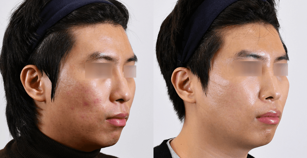 Scar/Pore #1 - 6 Months After (45°)