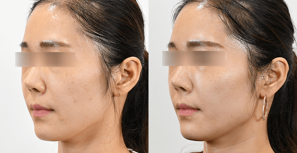 Skin Booster #1 - 3 Weeks After (45°)