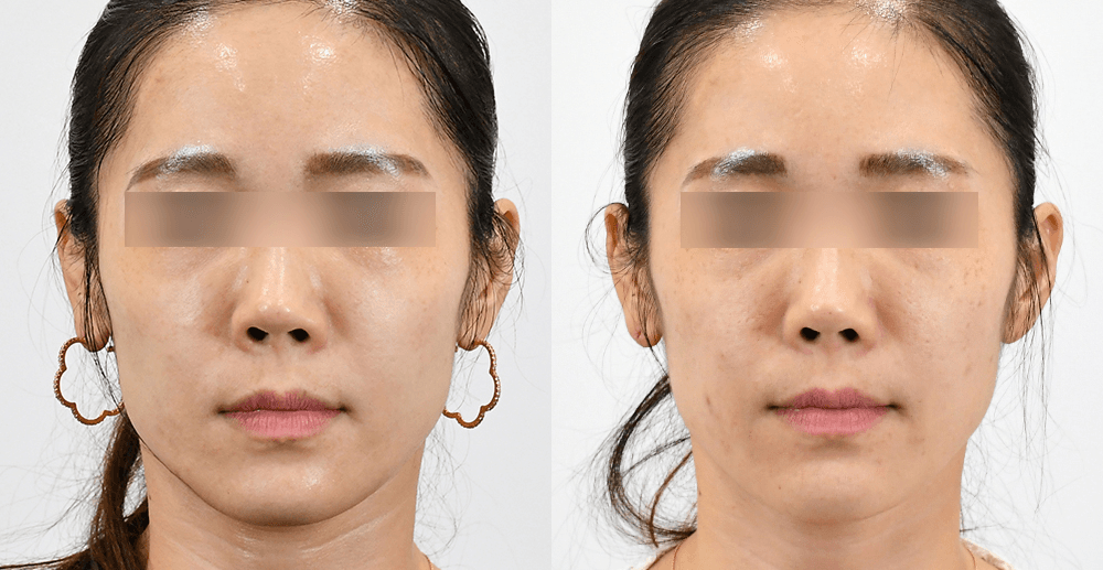 Skin Booster #1 - 3 Weeks After
