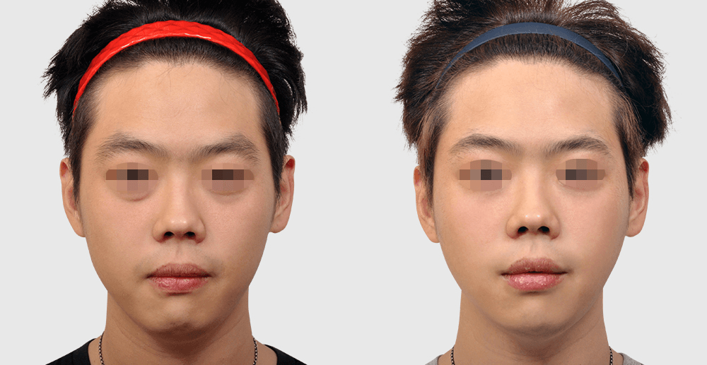 Thread Lifting #2 - 1 Month After