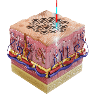 Fractional Laser Technology