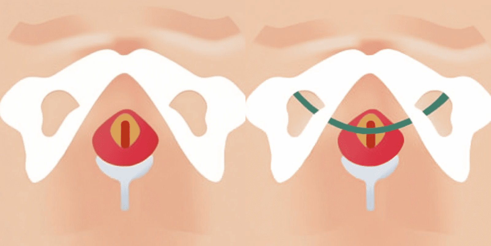 요실금 Mini Sling 수술 전후
