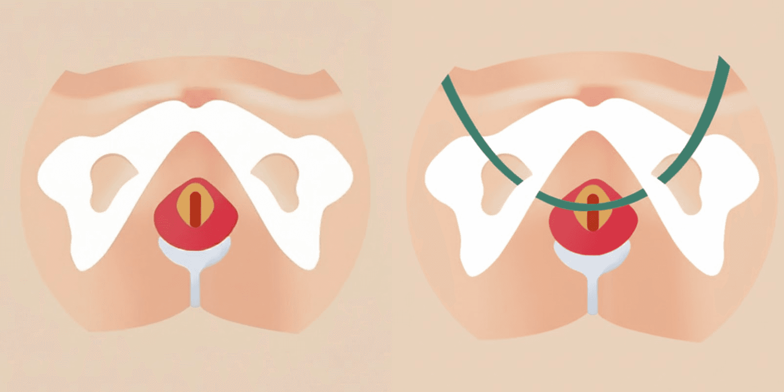 요실금 TOT 수술 전후