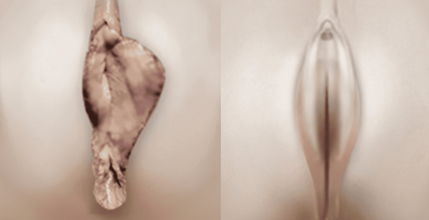 Labiaplasty Before / After (1)