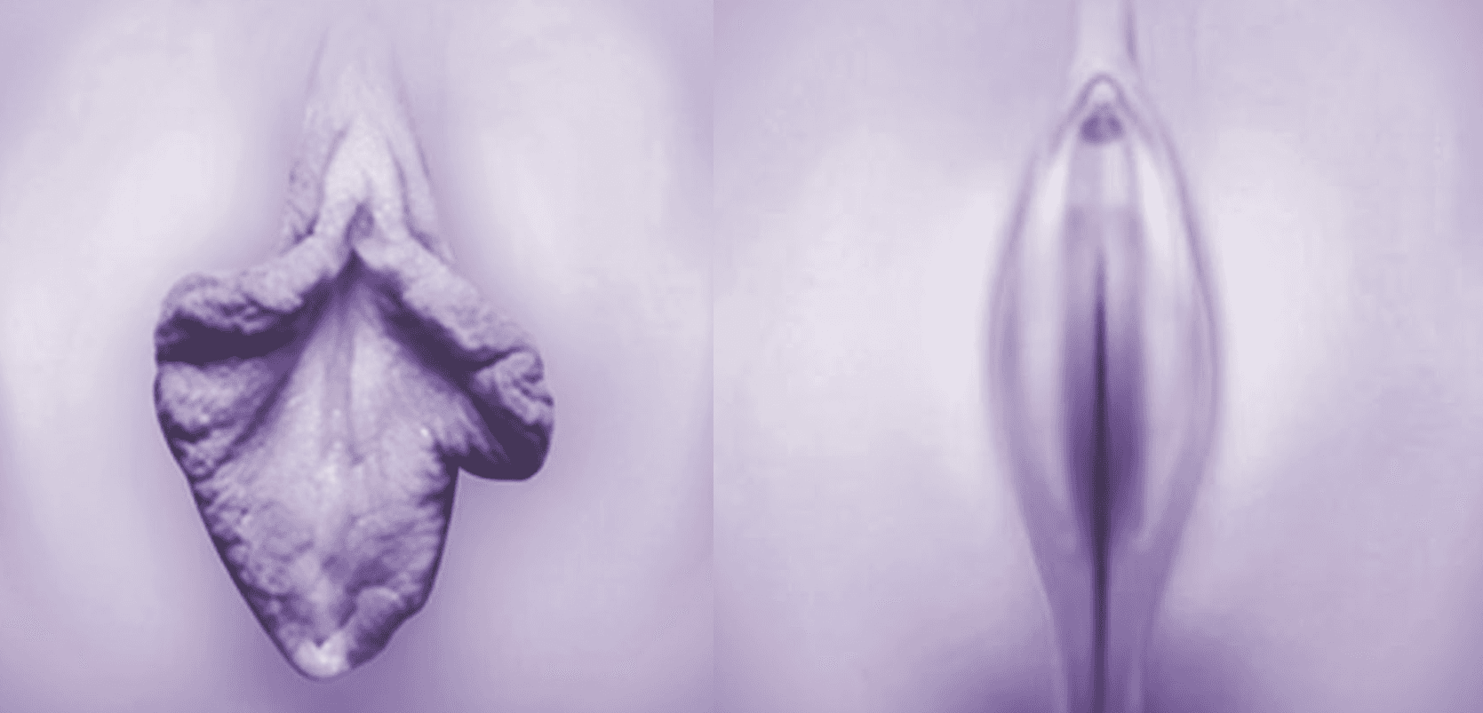 Labiaplasty Before / After (2)