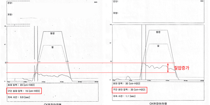 阴道压力改善案例4