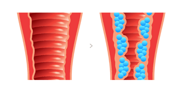 질필러 시술 전후 비교