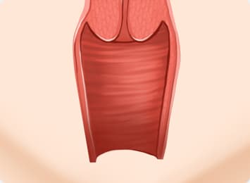 HD Implant Insertion