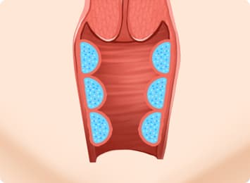 Vaginal Wall Contouring