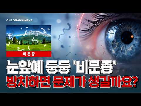 눈앞에 뭔가 떠다니는 비문증, 빠른 치료가 필요한 경우가 있다고?