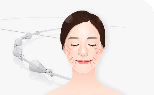 両方向コーンシステム