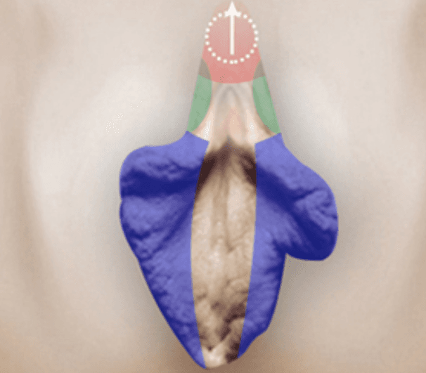 Upper Fold Tightening