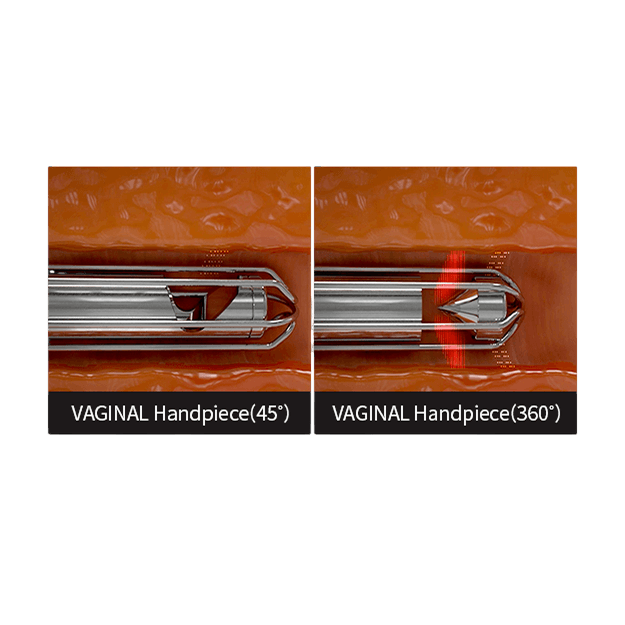 Multi-Angle Tip Application