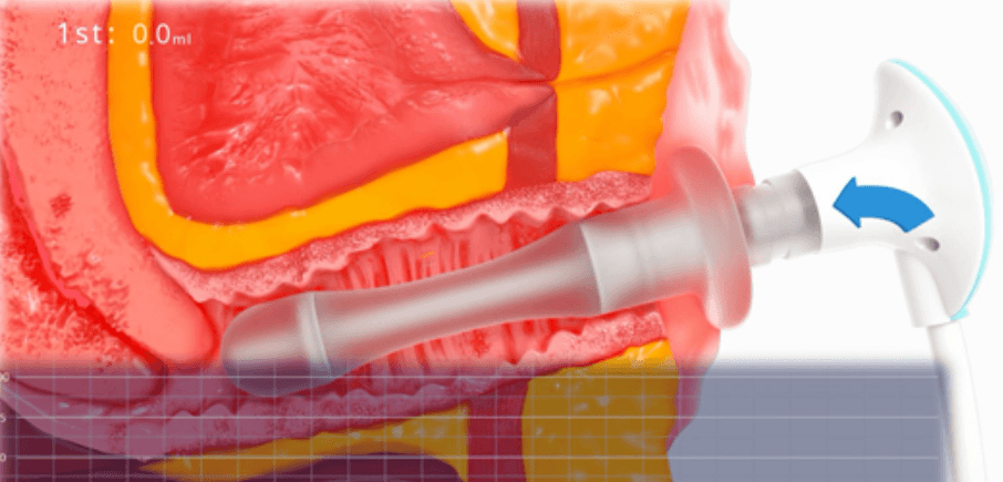 Sterile Equipment Insertion & Prep