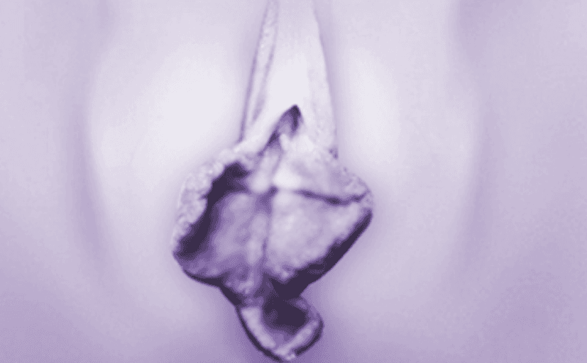 双侧肥大小阴唇