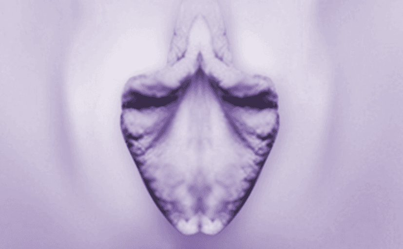 双侧肥大 + 阴蒂包皮连接