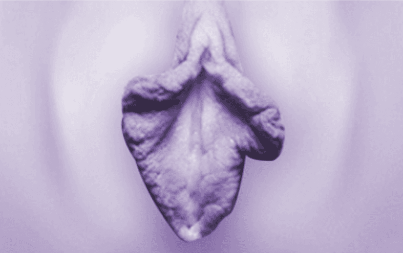 阴蒂包皮皱褶连接 + 皱纹较多的小阴唇