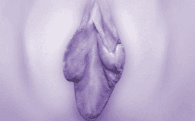 整体皱纹和松弛严重的小阴唇